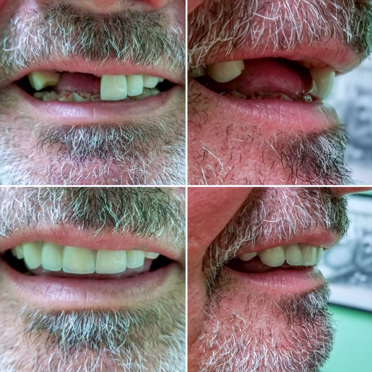 Before and after denture case